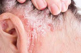 It can cause chronic infection and puts people at high risk of death from cirrhosis and liver cancer. Biologic Psoriasis Therapies Pose Limited Risk For Hepatitis B Reactivation Infectious Disease Advisor