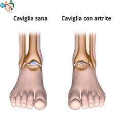 Dolore Alla Caviglia Cause Rimedi E Soluzioni