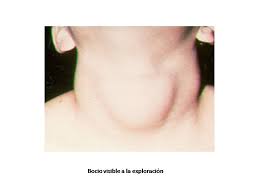 Tratamiento para la onicomicosis subungueal proximal. Hipertiroidismo