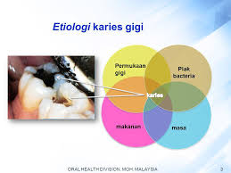 Oral health division malaysia (2017). Water Fluoridation A Public Health Approach In Caries Prevention Ppt Download
