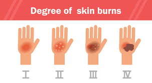 When To Seek Care For A Burn Hca Midwest Health Turn4thebetter