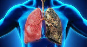 To learn more about how cancer causes are studied and classified, see known and probable human carcinogens and understanding cancer causes. How Smoking Causes Lung Cancer Tobacco Free Campus The University Of Texas At Austin