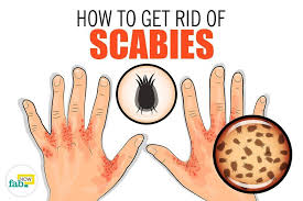 How To Get Rid Of Scabies With Home Remedies Scabies Scabies Treatment Body Itches
