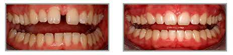 What is the cheapest price for braces? Straighten Teeth Without Braces South Africa Teethwalls