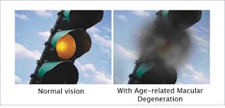 Image result for images Age-Related Macular Degeneration Risk