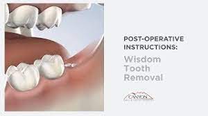 Post Operative Instructions Wisdom Teeth Removal At Canyon Oral Facial Surgery Dental Implant Experts