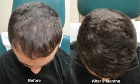 Second, the vials of blood are placed in a centrifuge machine where, due to the force of the centrifugal movement, the blood components are separated and isolated. Prp Hair Restoration Ziva