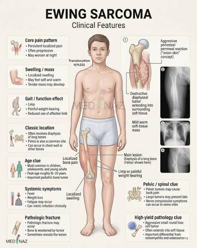 Ewing Sarcoma: Highly malignant small round blue cell tumor that usually  arises in bone and affects children and adolescents. It is strongly  associated with a characteristic chromosomal translocation. 🔹 Age Group ➟