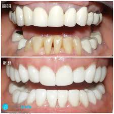 Routine dental treatments include tooth cleaning and polishing, tooth removals, gum surgeries, impaction or third molar removals,tooth colored fillings, root canal treatments and crown and bridge and teeth problems in children. Perfect Smile Dental In Tijuana Mexico Read 39 Reviews