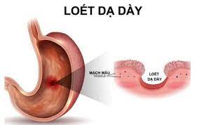 Maybe you would like to learn more about one of these? Cac Bá»‡nh ThÆ°á»ng Gáº·p á»Ÿ Dáº¡ Day Vinmec