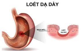 But you can keep heartburn in check with the right treatment, like a medicine or lifestyle change. Cac Bá»‡nh ThÆ°á»ng Gáº·p á»Ÿ Dáº¡ Day Vinmec