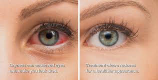 Image result for Dry Eye