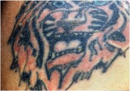 One person even got their entire vaccine card printed on their arm. Tattoo And Vaccination Sites Possible Nest For Opportunistic Infections Tumors And Dysimmune Reactions Sciencedirect