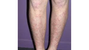 Image result for allergy rash on the legs