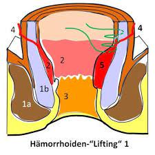 Symptome erkennen ✓ schmerzen lindern ✓ erfolgreich behandeln. Hamorrhoiden Op Nurnberg Klinik Hallerwiese De