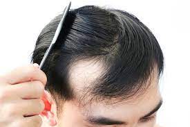 The extent to which your scalp is affected by. Why Men Are Balding In Their 20s Vargas Face And Skin Center