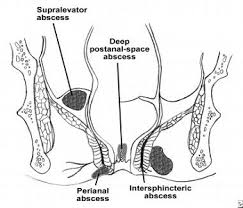 Image result for Ischiorectal Abscess