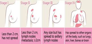 Image result for Breast Cancer Staging