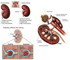 Diabetic Nephopathy Chronic Kidney Disease Kidney Disease Renal Disease