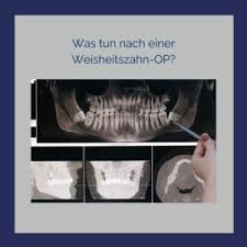 Wir erklären dir, was du nach dem eingriff essen kannst und auf welche speisen du erstmal verzichten solltest. Was Tun Nach Der Weisheitszahn Op Dr Zikarsky Kollegen Nurnberg