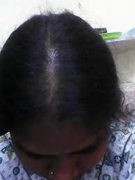 While this may most certainly spark a sense of anxiety, it is a normal process as the minoxidil starts to alter how your scalp produces hair. Hair Loss Increased After Changing Minoxidil 5 To 2 Is This Normal Photo