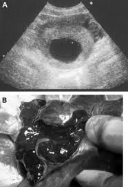 Image result for corpus luteum sonography)