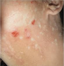 Morgellons disease should be treated as early as possible to improve the ultimate outcome that a patient will achieve. Morgellons A Novel Dermatological Perspective As F1000research