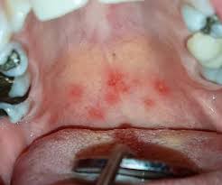 Image result for Oral herpes roof of mouth