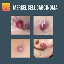 Image result for Merkel Cell Carcinoma