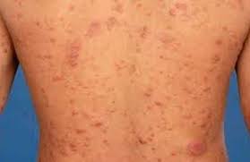 Lepra currently works in india, bangladesh, zimbabwe and mozambique. Lepra 373 Casos Reportados En Colombia El Quindiano