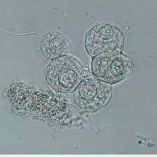 Renal Tubular Epithelial Cells Medical Technology Medical Laboratory Science Urinal