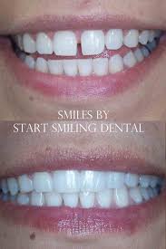 Clear Correct Orthodontics In Atlanta Ga 30328 This Patient Disliked The Large Space Between Her Front Teeth Her Lowe Orthodontics Smile Dental Teeth Bonding