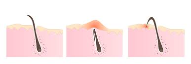 This is followed by raised bumps, which are often called armpit razor bumps. The Ultimate Guide To Ingrown Hair Removal