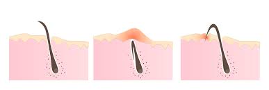 This is followed by raised bumps, which are often called armpit razor bumps. The Ultimate Guide To Ingrown Hair Removal