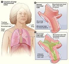 Bronchitis Wikipedia