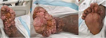 Madura foot is a chronic infection of the skin and underlying tissues caused by both bacteria (actinomycotic mycetoma or actinomycetomas) and fungi (eumycetomas or mycotic mycetoma). Madura Foot In A Developed Tropical Country International Journal Of Infectious Diseases