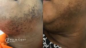 Leaves skin softer than before. Laser Hair Removal Dark Skin Pulse Light Clinic London