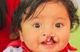 Atencion Dr.Raul Rodriquez a pacientes naciedo con fisura palatina.