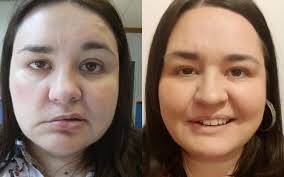 It is usually temporary — most people start to get better in 2 weeks and. I Woke Up With A Broken Face Living With Bell S Palsy By Amy Green United Response