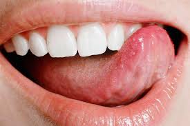 Nevertheless, if find your own. Canker Sores All You Need To Know About Symptoms Treatment Rozenberg Dental Nyc General Dentists