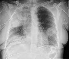 Legionella pneumonia tends to be more prevalent among immunocompromised patients. Legionella Pneumonia Radiology Case Radiopaedia Org