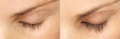 The applicator brush can then be used to spread the solution. Latisse Mclean Dermatology Skincare Center
