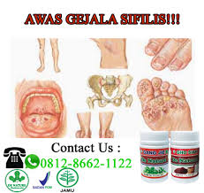Keluarnya cairan atau kotoran dari penis. Storymapjs Inilah Ciri Ciri Gejala Penyakit Sipilis Yang Perlu Diwaspadai