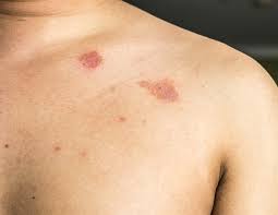 Yellow fungus symptoms and causes: Symptoms Of Ringworm
