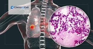 Symptoms of lung cancer in men are a bit different from those in women. Lung Cancer Symptoms And Treatment By Stages Clinics On Call