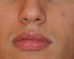 Although it is harmless, hardly anyone can accept the ugliness it brings to the delicate parts of the body. Fordyce Spots Fordyce Spots On Lips Cure