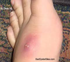 The spider itself has a distinctive red hourglass pattern on its body. Staph Infection Badspiderbites Com