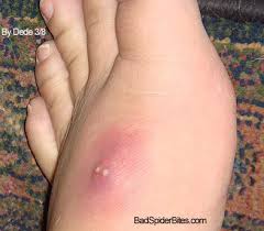 Spider bite symptoms,treatment, photos, pictures of brown recluse spider bite, wolf spider bite, white tail spider bite treatment. Staph Infection Badspiderbites Com