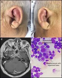Image result for Relapsing Polychondritis