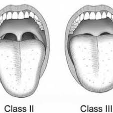 Learn about sleep apnea, including a description of types of sleep apnea, symptoms, treatment primary snorers usually have a score less than 10, and individuals with moderate to severe sleep apnea usually have a score greater than 16. Pdf Modified Mallampati Score Improves Specificity Of Stop Bang Questionnaire For Obstructive Sleep Apnea